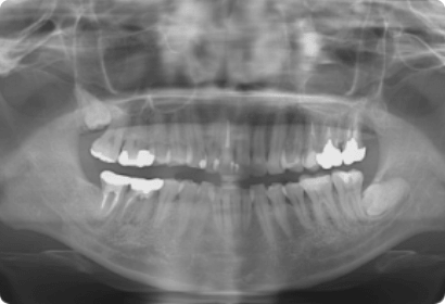 デジタルレントゲン2