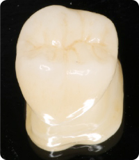 セラミック歯を口腔内へセット