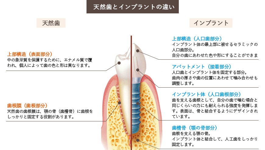 インプラント説明写真１