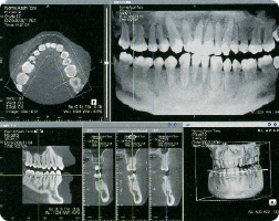 歯科用ＣＴ・口腔内全体