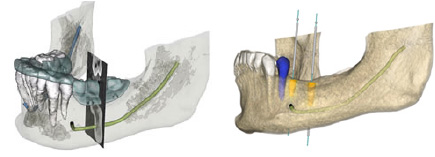 グラフフィックガイドを口に入れてCT撮影