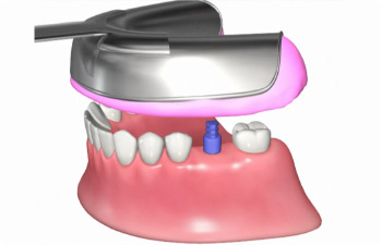 被せ物の型取り
