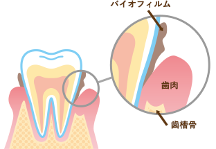 バイオフィルムは歯ブラシの先が届きにくい場所にくっつきます