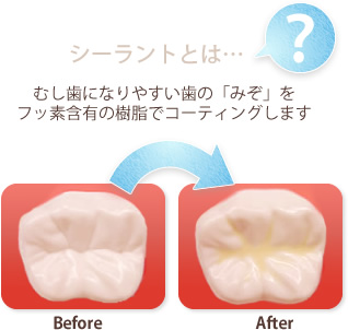シーラントとは・・　むし歯になりやすい歯のみぞをフッ素含有の樹脂でコーティングします