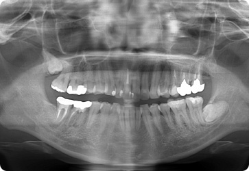 レントゲン検査