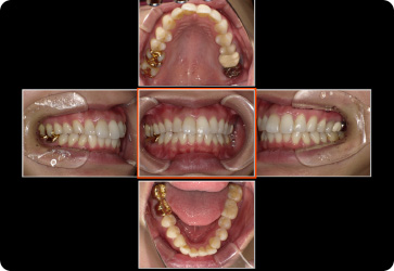口腔内写真